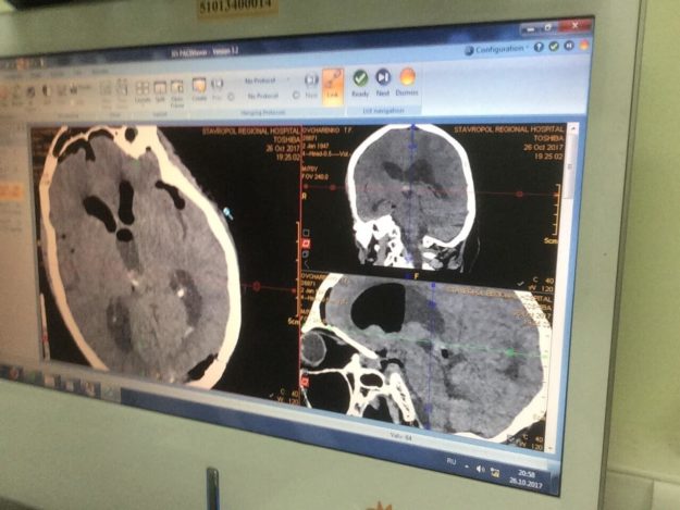 Нейрохирурги Краевой больницы успешно удалили опухоль III желудочка головного мозга