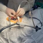 Нейрохирурги СККБ провели первую операцию с видеоскопической ассистенцией 