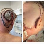 Хирурги Ставропольского онкологического диспансера и Ставропольской краевой клинической больницы провели сложную операцию пациенту с раком кожи волосистой части головы